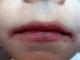 Потрескались губы: причины и методы лечения