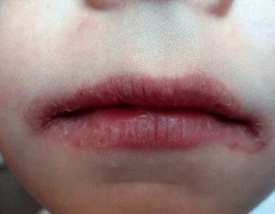 Потрескались губы: причины и методы лечения